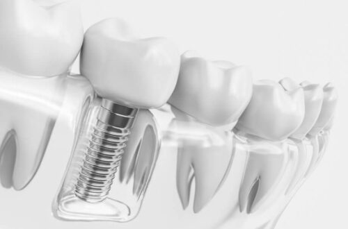 Implanty Dentysta