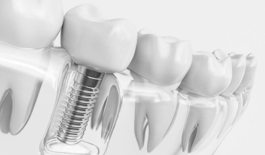 Implanty Dentysta